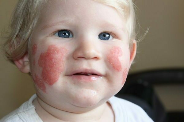 melon allergy
