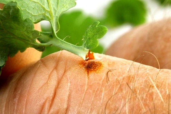 celandine application